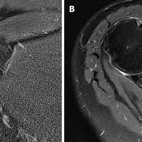 Magnetic Resonance Imaging Of The Right Shoulder Before Surgery A The