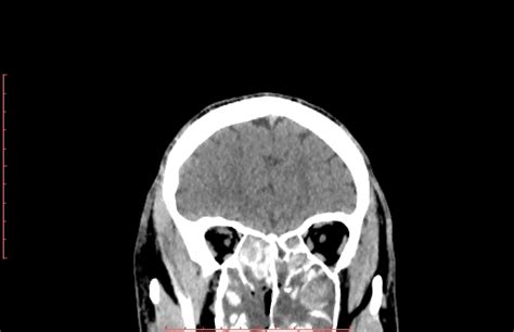 Chronic Invasive Fungal Sinusitis Image