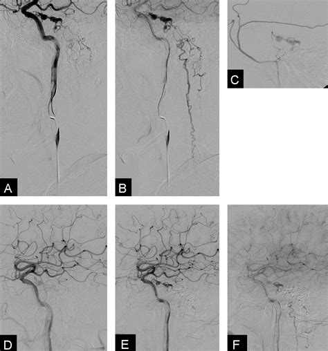 Carotid Cavernous Fistula With Cervical Myelopathy Journal Of Clinical Neuroscience