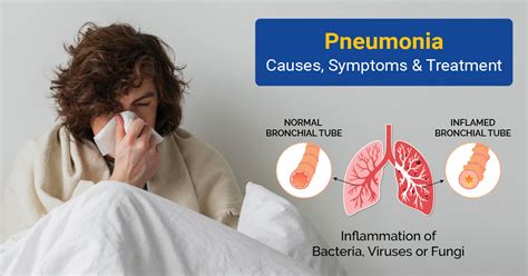 Pneumonia Causes Symptoms And Treatment