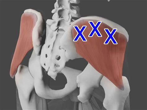 Gluteus Medius Pain At Iliac Crest