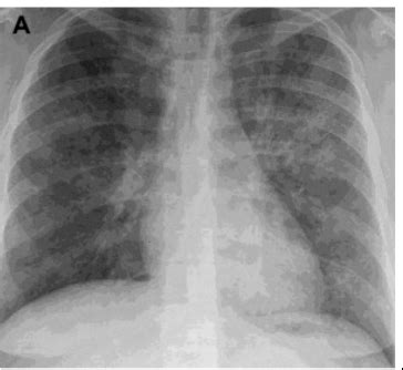 Chest X Rays Flashcards Quizlet