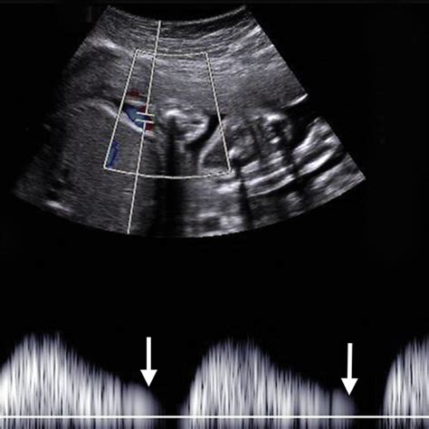 A Radiologists Guide To The Performance And Interpretation Of Obstetric Doppler Us Radiographics