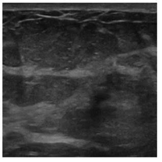 Ultrasound Images And Mask Combined From The BUSI Dataset A Malignant