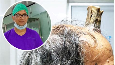 Doctors Remove 10cm Sebaceous Horn From Head Of Indian Man 7news