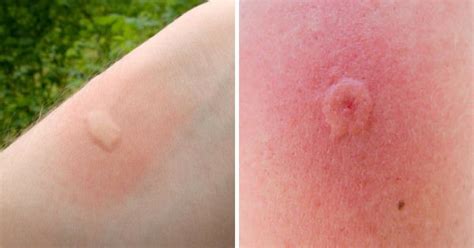 two pictures of the same person's skin and one with red spots on it