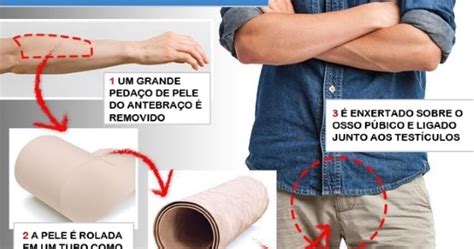 Falando sobre Pênis Homem que nasceu Sem Pênis está prestes a