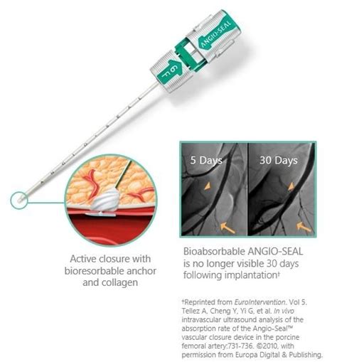 ANGIO-SEAL™ VIP VASCULAR CLOSURE DEVICE