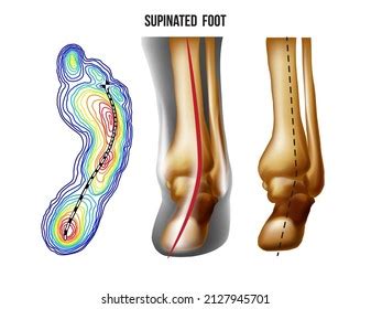 362 Supinated Foot Images, Stock Photos & Vectors | Shutterstock