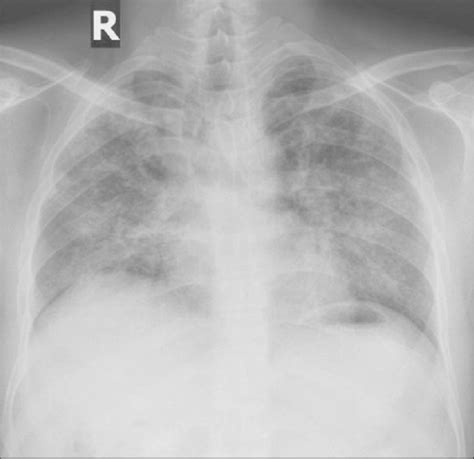 Digital Chest Radiograph Posterior Anterior View Showing Bilateral