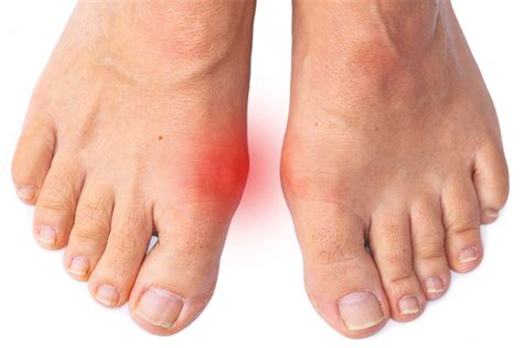 Bunions Advantage Foot Ankle Specialist Ferndale M