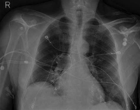 Coil Embolization Of Pulmonary Arteries As A Palliative Treatment Of