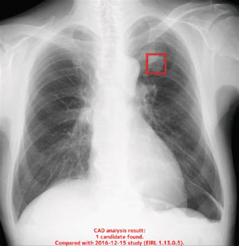 Eirl Chest Screening Eirlエイル Ai画像診断支援技術 エルピクセル株式会社