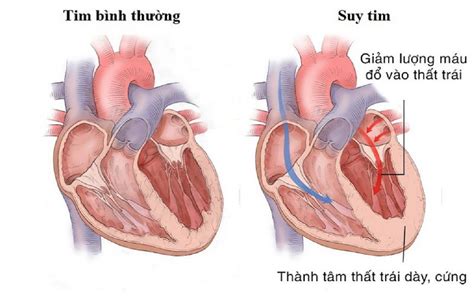 Suy tim cấp Nguyên nhân triệu chứng chẩn đoán điều trị