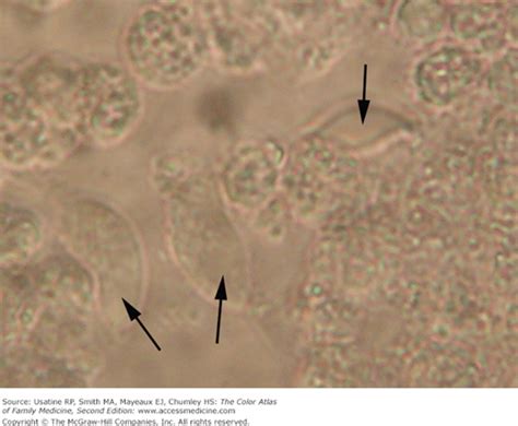 Trichomonas Vaginitis Basicmedical Key