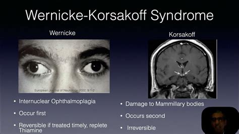 Wernickes Korsakoff Syndrome Youtube