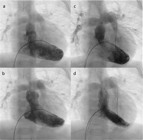 Percutaneous Pulmonary Artery Debanding Journal Of Cardiology