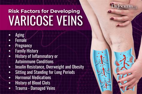 Varicose Veins Symptoms Causes And Natural Support Strategies