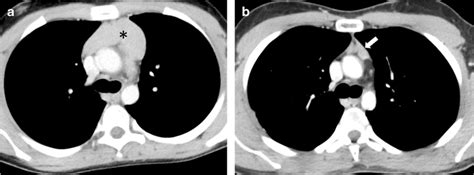 Thymic hyperplasia in a 14-year-old boy with Hodgkin lymphoma. a Axial... | Download Scientific ...