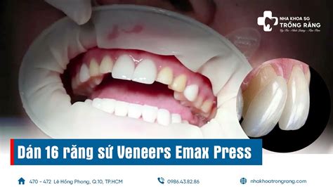 D N S Veneers Emax Press Cho R Ng Youtube