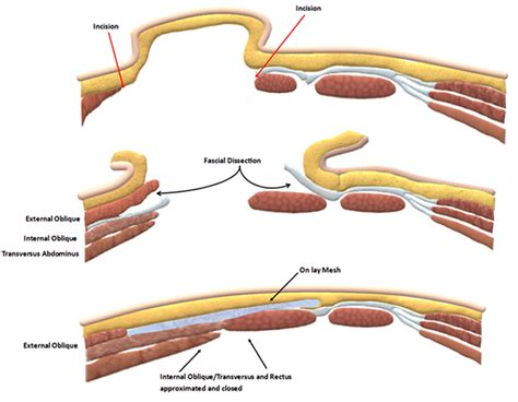 Spigelian Hernia Anatomy