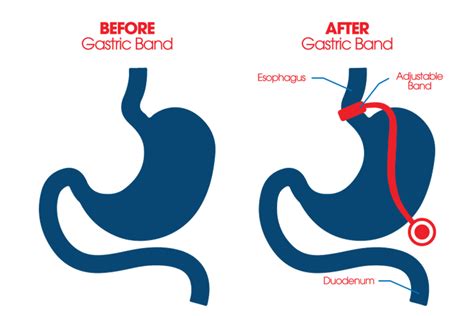 Gastric Band - Bariatric Surgery Tijuana - Stop Obesity