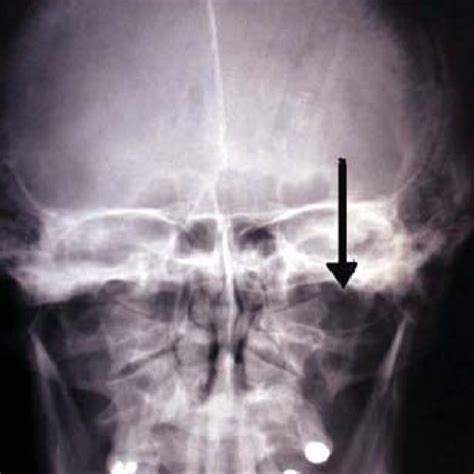 (PDF) Gorlin-Goltz syndrome