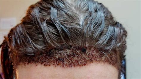 Unexpected Turn Hair Transplant Gone Wrong Mcan Health Blog