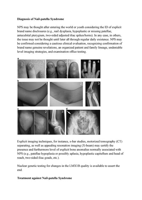 Diagnosis And Treatment Of Nail Patella Syndrome Diagnosis Of Nail