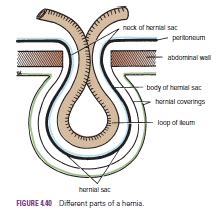 Human Medecine: Abdominal Herniae-Indirect Inguinal Hernia-Direct ...