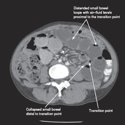 Small Bowel | Radiology Key