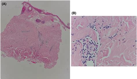 Histopathology A Photomicrograph Shows Square Shape Punch Biopsy With