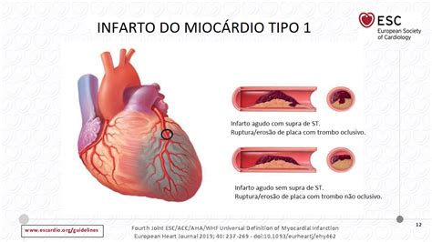 Infarto Do Miocárdio Michel Kalansky