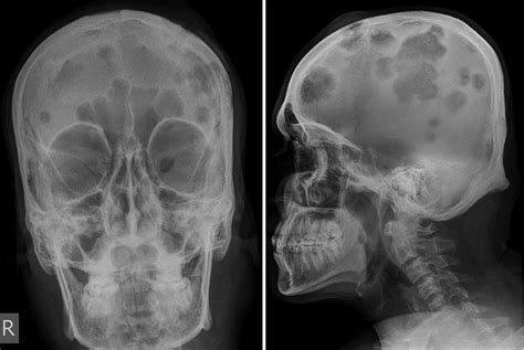 Large Fibro Osseous Lesion Skull