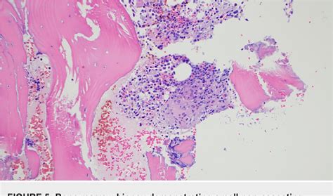 PDF Extrapulmonary Sarcoidosis With Multi Organ Involvement