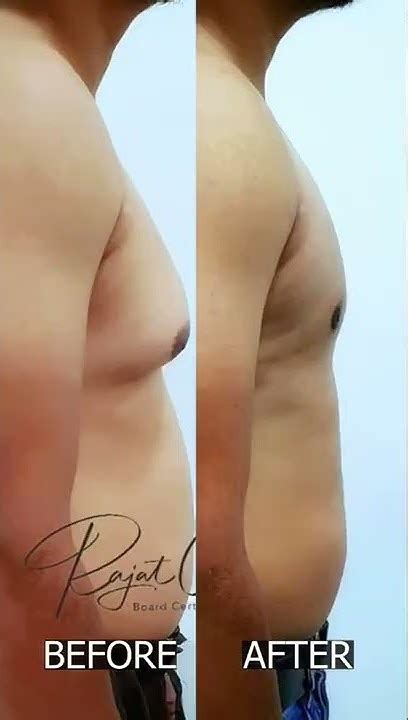 Results Of Gynecomastia Surgery Dr Rajat Gupta Board Certified Plastic Surgeon In Delhi Youtube