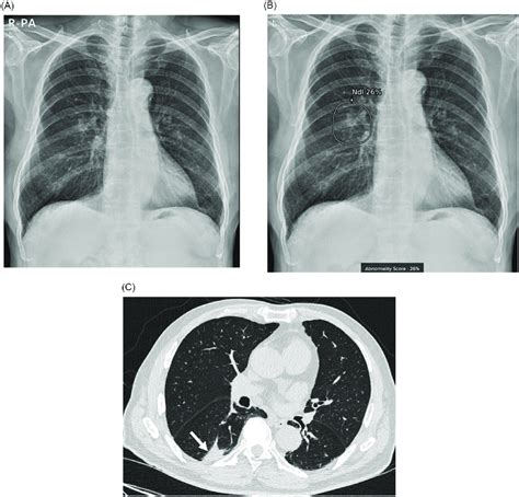 Chest Radiograph And Computed Tomography CT Of A 79 Year Old Man 13