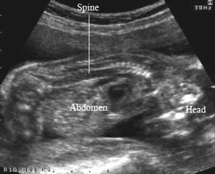 Sagittal Sonogram Of The Spine Showing Markedly Hypoechoic Anterior