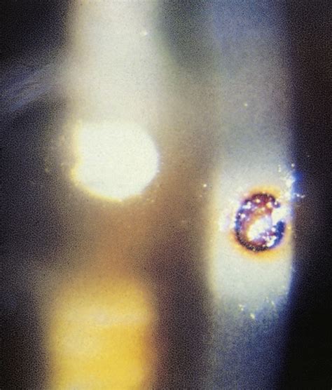 Foreign Body Corneal Anesthesia Key