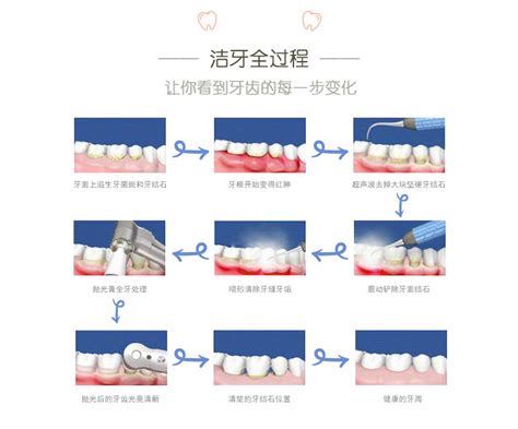 洗牙过程中出血正常吗 爱康健齿科