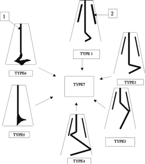 Deviated Nasal Septum Types