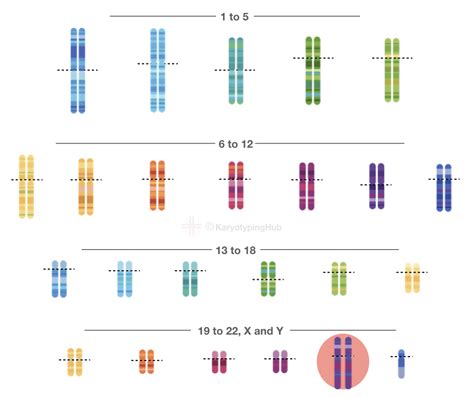 Klinefelters Syndrome Karyotype