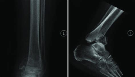 Anteroposterior A And Lateral B Radiographs Of The Left Ankle