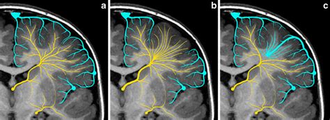 Patterns Of Drainage In Developmental Venous Anomalies Dvas A Normal