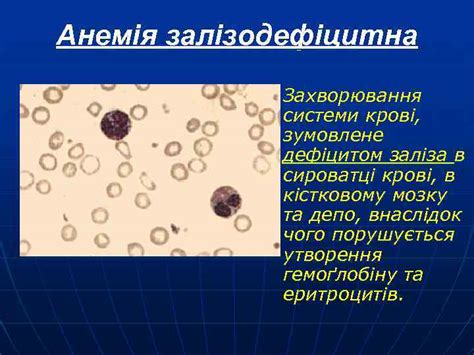 Презентація на тему ДИФЕРЕНЦІЙНА ДІАГНОСТИКА АНЕМІЙ виконала студентка