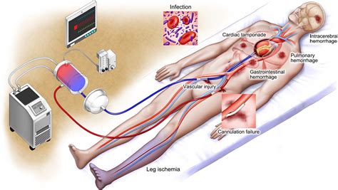 Extracorporeal Cardiopulmonary Resuscitation For Outofhospital