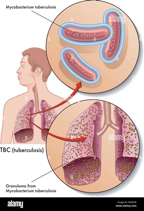 Bacillus Tuberculosis Stock Vektorgrafiken Kaufen Alamy