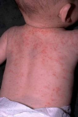 Dermatologic Manifestations Of Wiskott Aldrich Syndrome Clinical