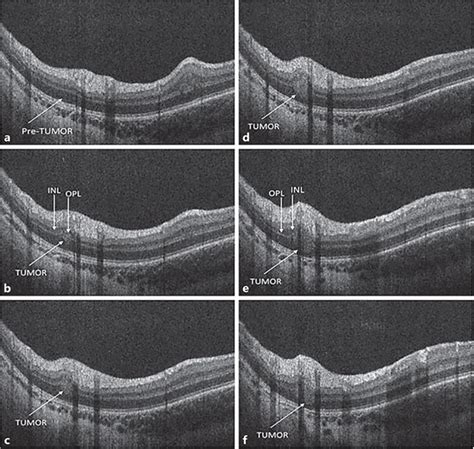 Oct Images Of A Week Old Male With A Germline Retinoblastoma