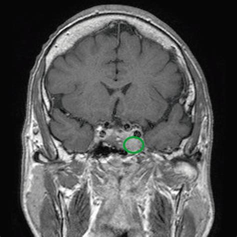 Pituitary Gland Cyst Mri